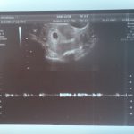 Baby Kyriakidou 1st Scan & Heart Beat