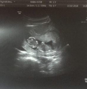Baby Kyriakidou 3 Month Scan