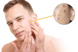 Skin Pigmentation in Men